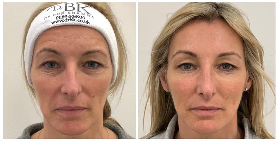 Before & After Cheek Sculpting Before & After Cheek Sculpting