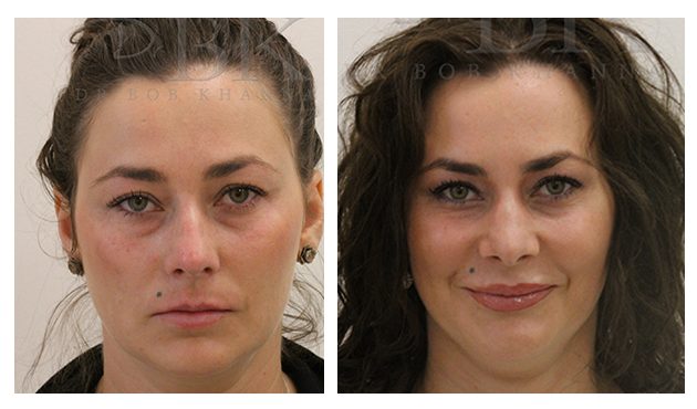 Full Face Treatment: Lips, Tear Troughs, Nose, Chin & Jawline