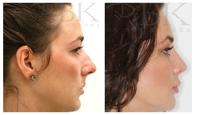 Full Face Treatment: Lips, Tear Troughs, Nose, Chin & Jawline