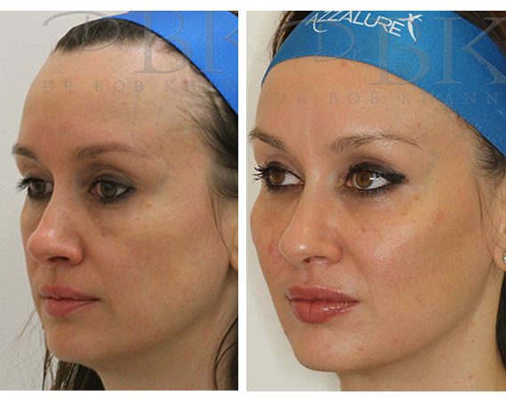 Full Face Treatment: Lips, Cheeks, Tear Troughs, Chin & Jawline