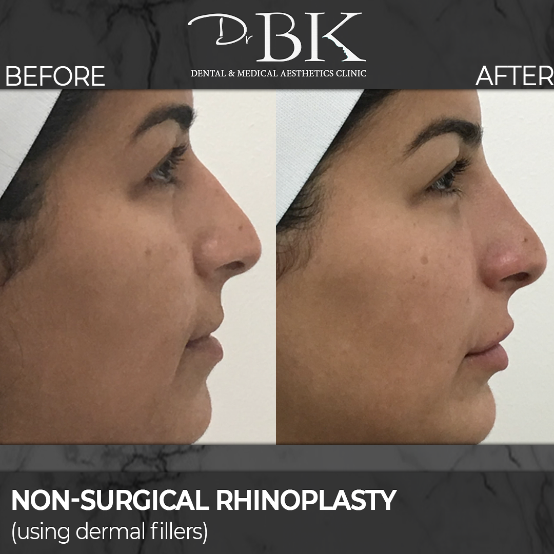 Non-surgical rhinoplasty before and after