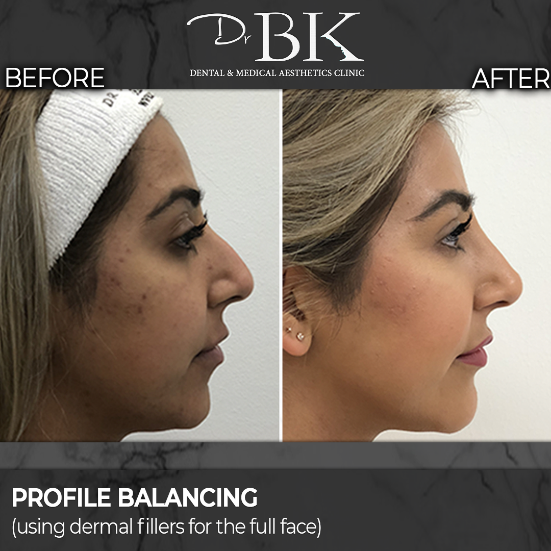 Non-surgical rhinoplasty before and after