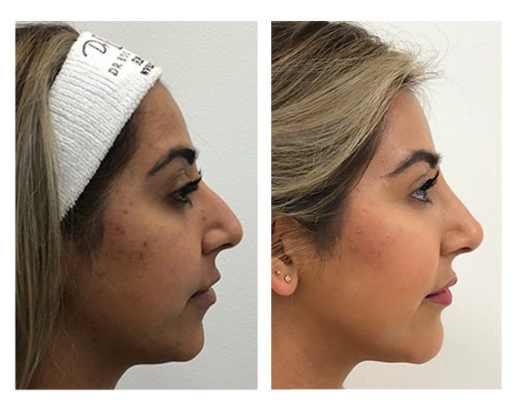 Profile Balancing: Nose, Tear Troughs, Lips, Chin & Jawline