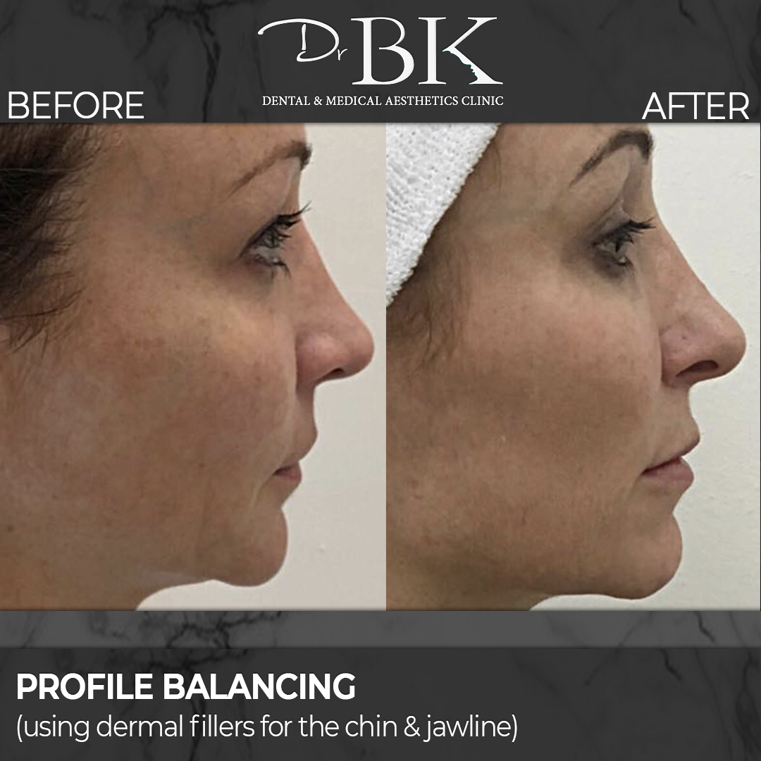 Chin & Jawline Augmentation (using dermal fillers) at DrBK - Before and After Transformation