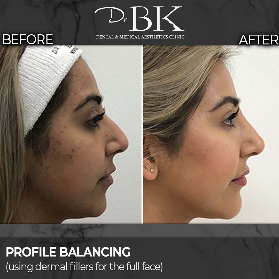 Profile Balancing: Tear Troughs, Cheeks, Nose, Chin, Jawline & Lips