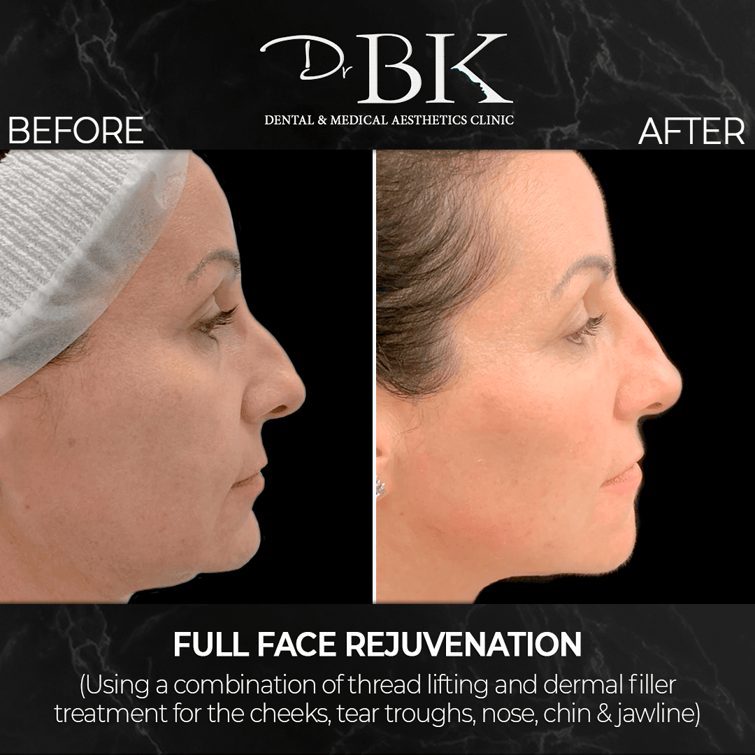 Non-Surgical FaceLift Non-Surgical FaceLift