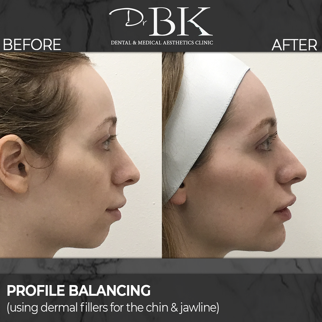 Lip & Augmentation (using dermal fillers) at DrBK - Before and After Transformation