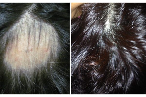 Anti Hair Loss/Hair Rejuvenation - After 3 PRP Sessions