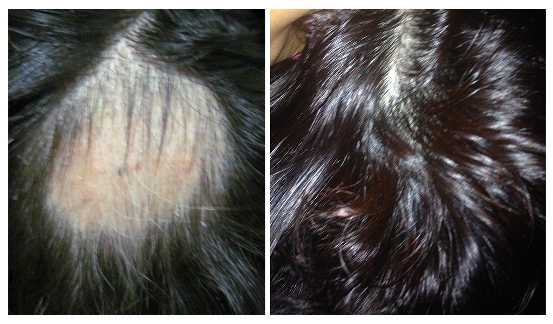 Anti Hair Loss/Hair Rejuvenation - After 3 PRP Sessions