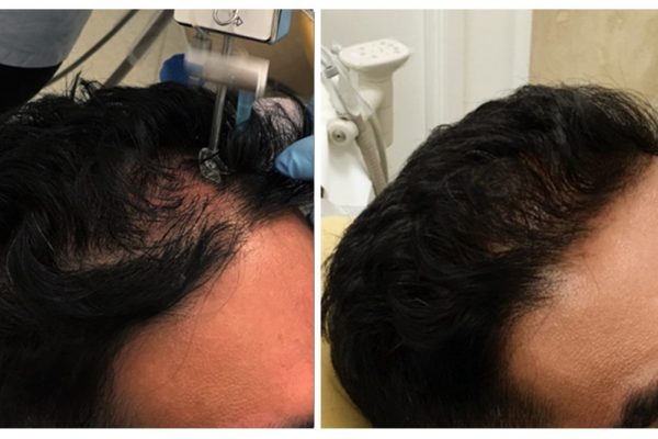 Hair Loss Treatment - Injectable Anti-Hair Loss Treatment at DrBK Hair Loss Treatment - Injectable Anti-Hair Loss Treatment at DrBK