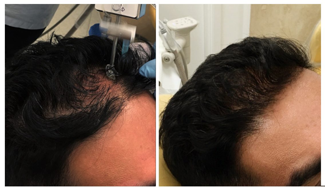 Hair Loss Treatment - Injectable Anti-Hair Loss Treatment at DrBK