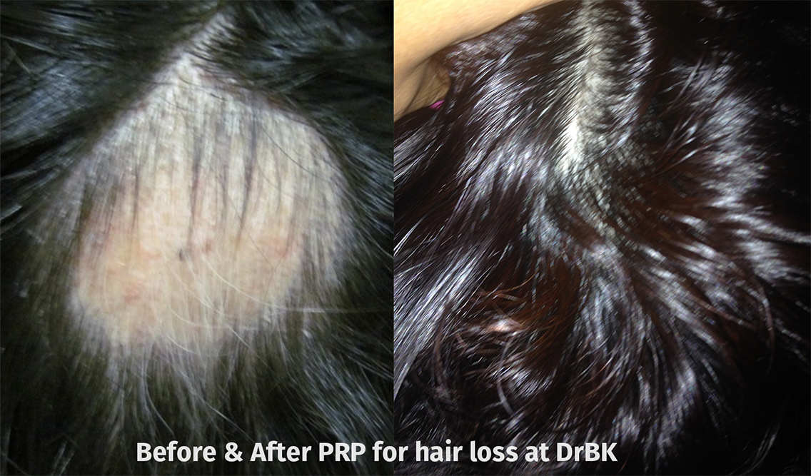 PRP hair loss