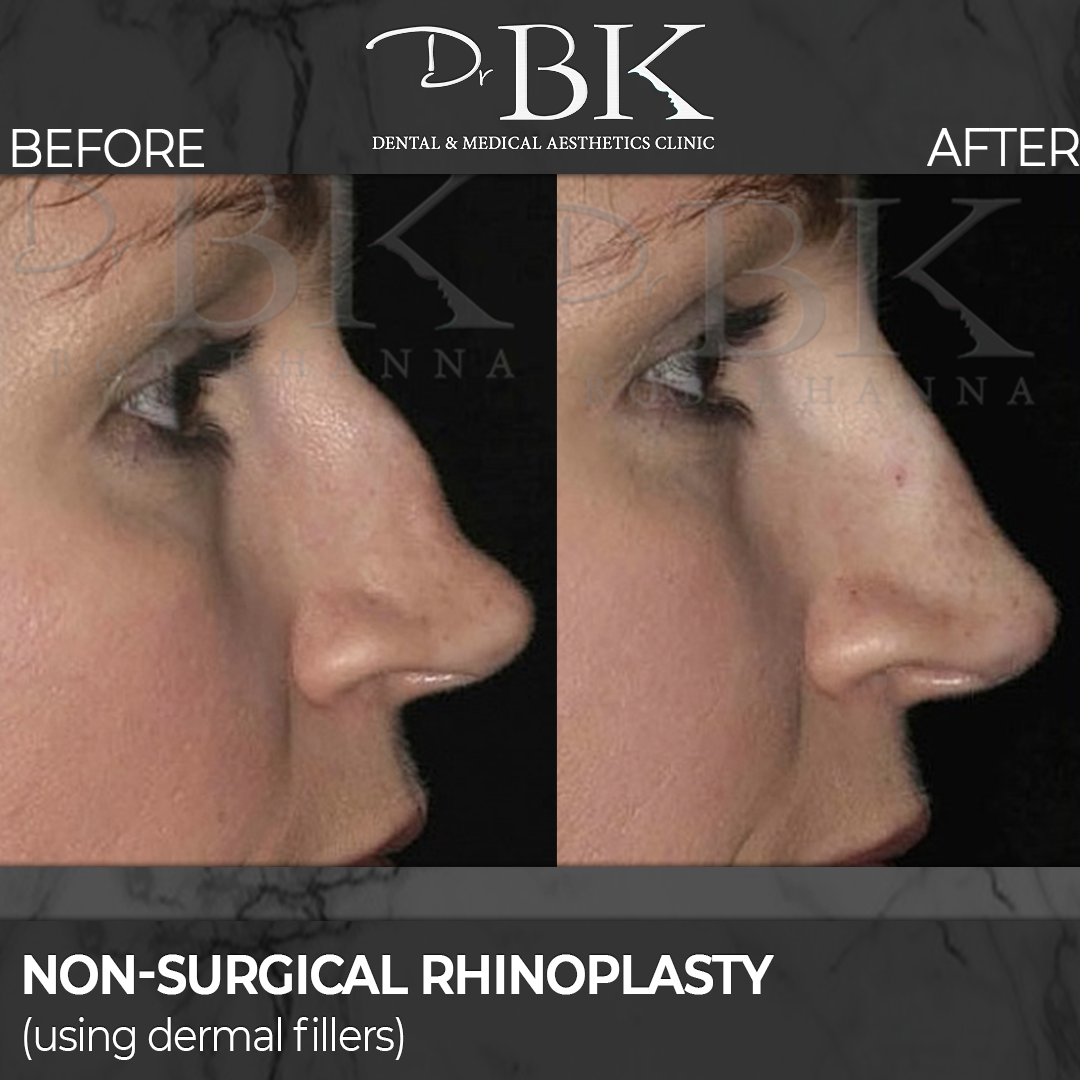 Non-surgical rhinoplasty before and after