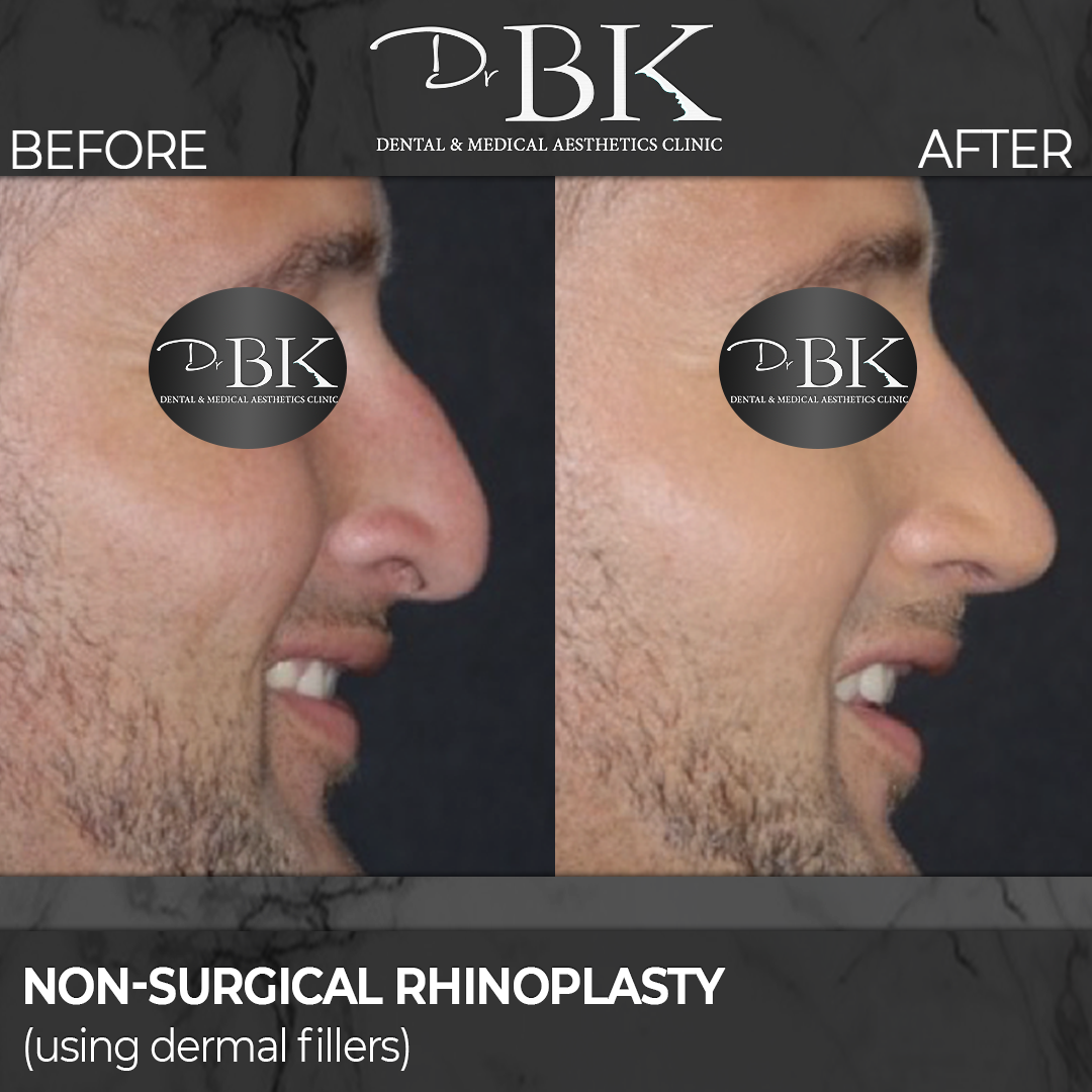 Non-surgical rhinoplasty before and after