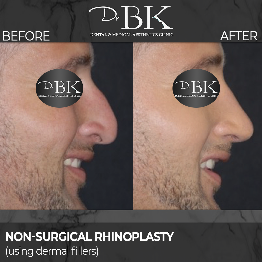 non-surgical rhinoplasty - dermal fillers