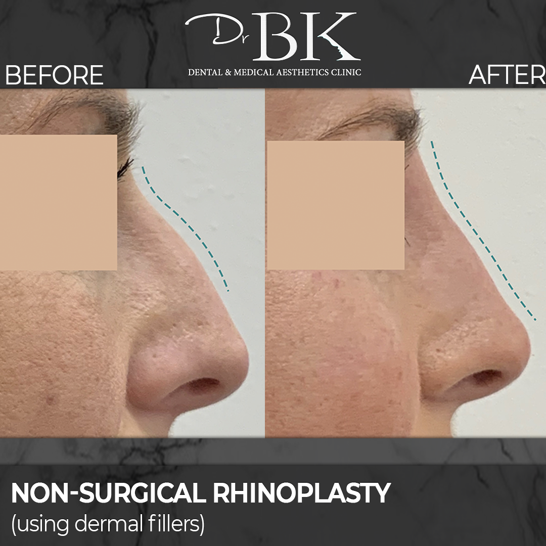 Non-surgical rhinoplasty before and after