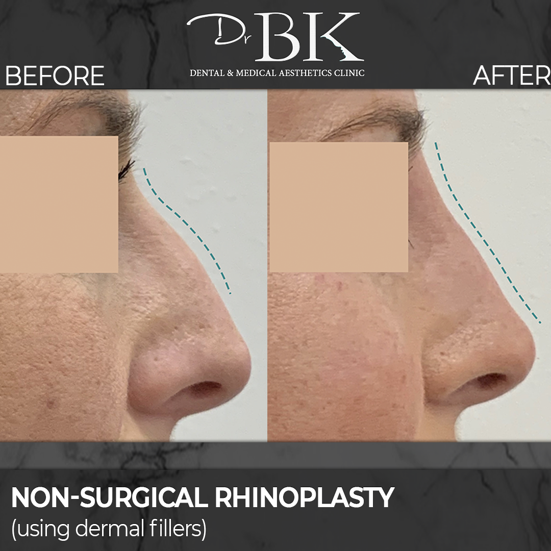 non-surgical rhinoplasty - dermal fillers
