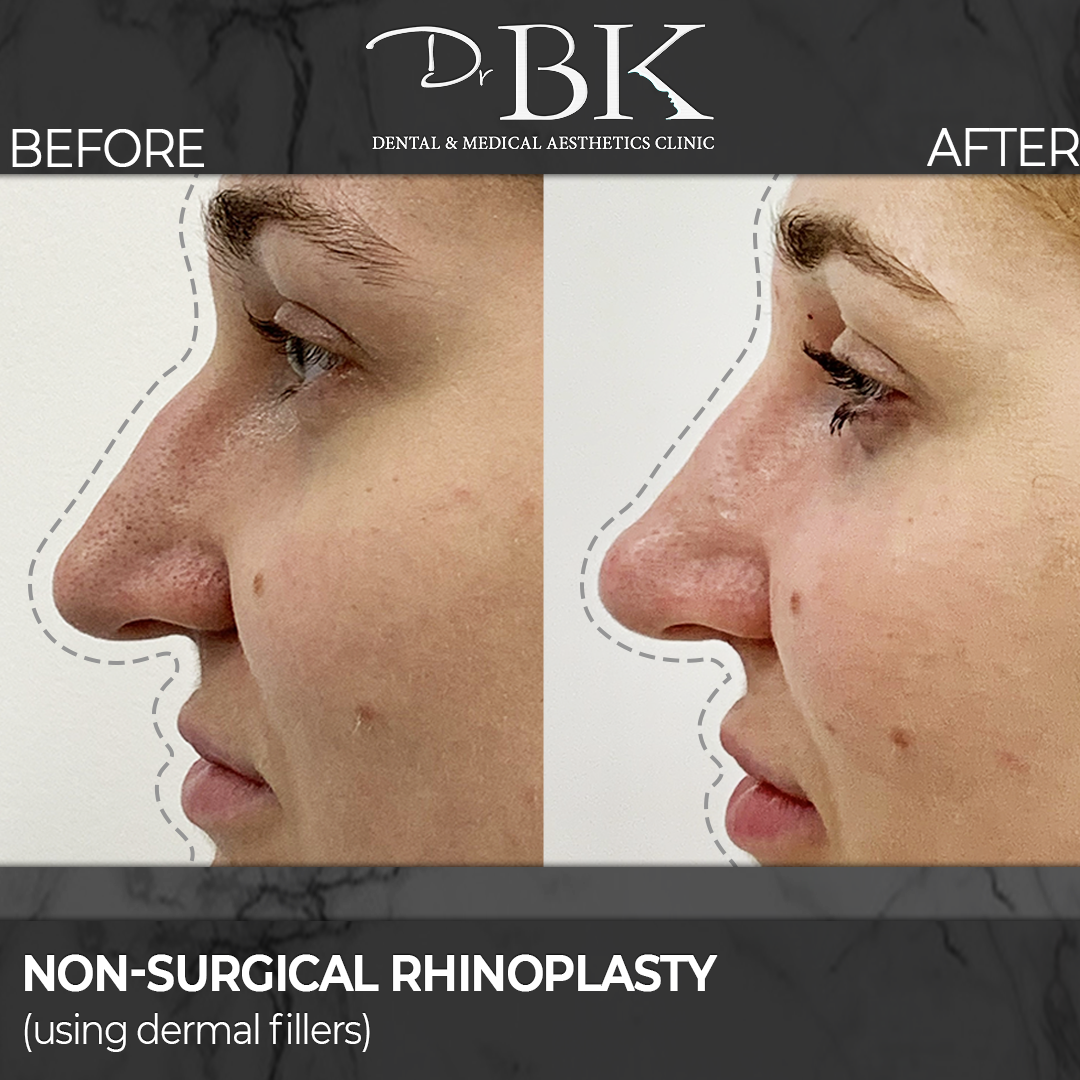 Non-surgical rhinoplasty before and after