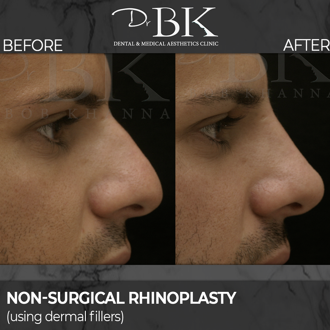 Non-surgical rhinoplasty before and after