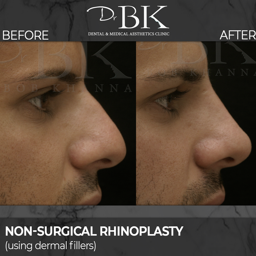 non-surgical rhinoplasty - dermal fillers