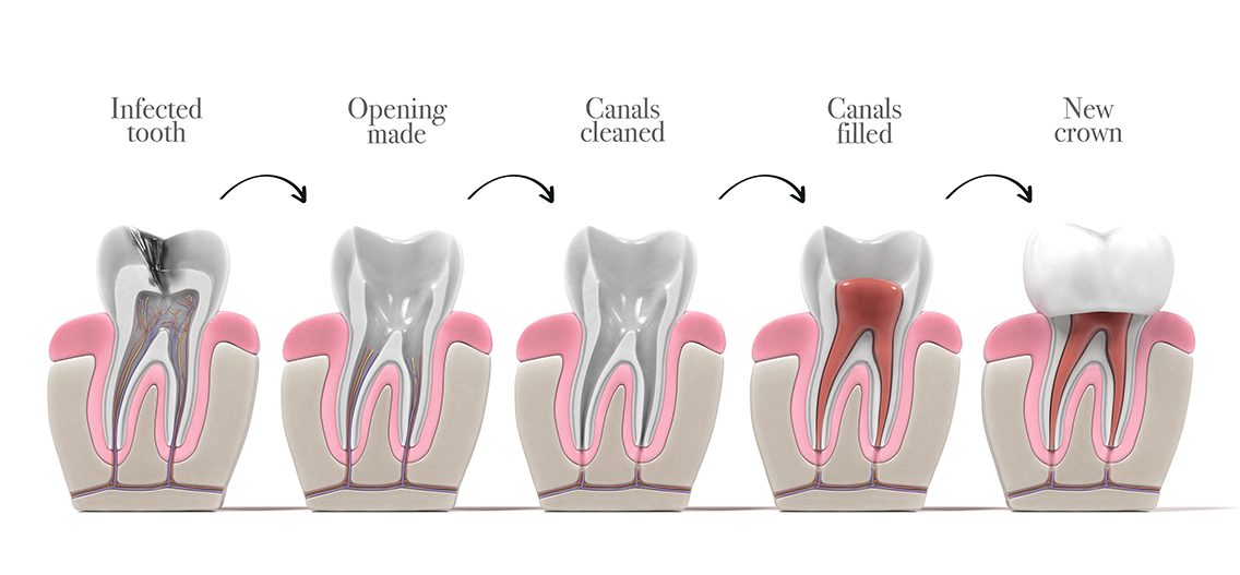 root-canal-procedure-dental