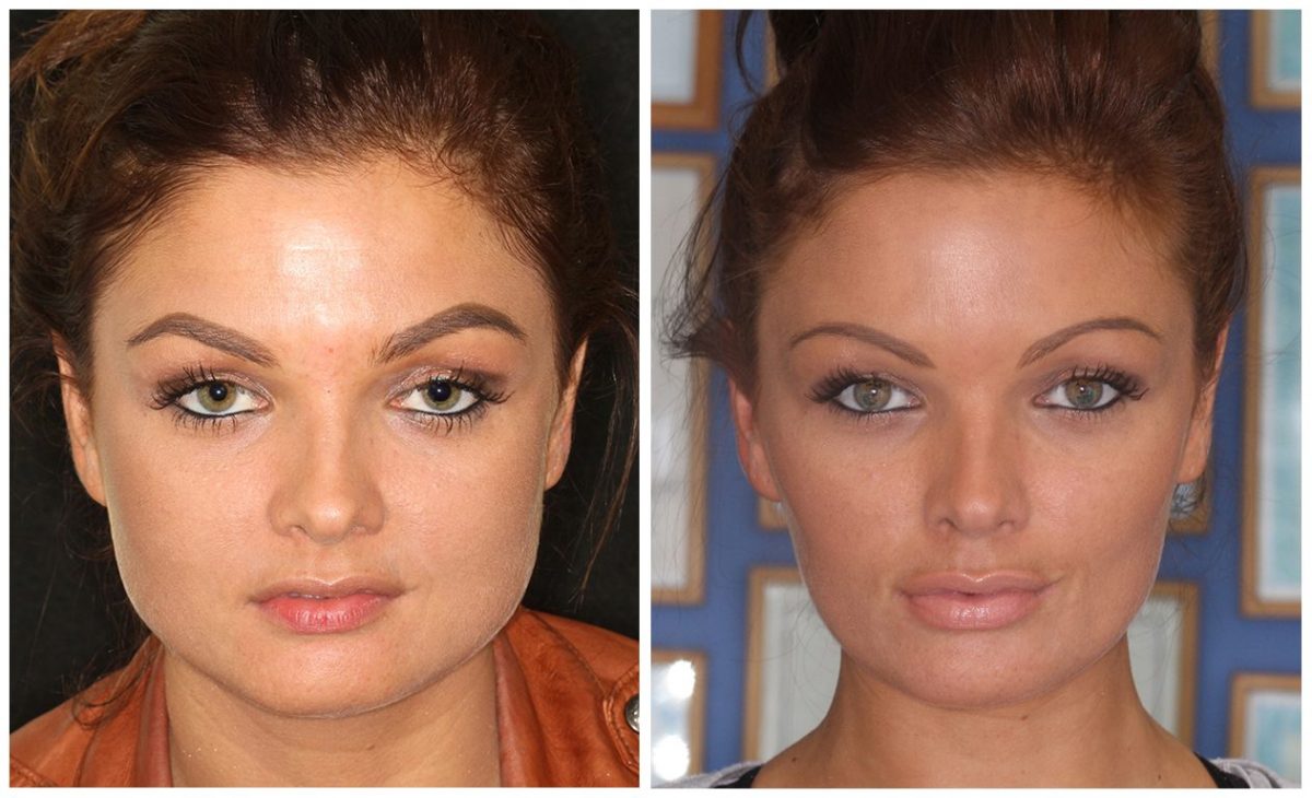 Before & After Facial Slimming