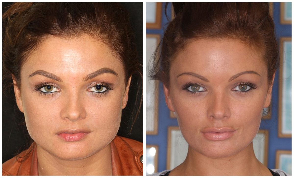 Non Surgical Facial Slimming Reshape Your Face DrBK