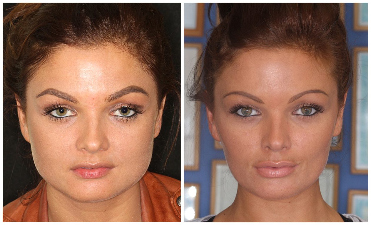 Before & After Facial Slimming