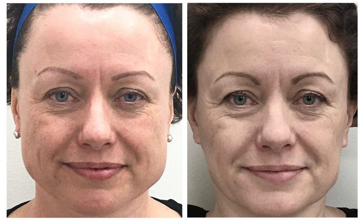 Before & After Facial Slimming Before & After Facial Slimming