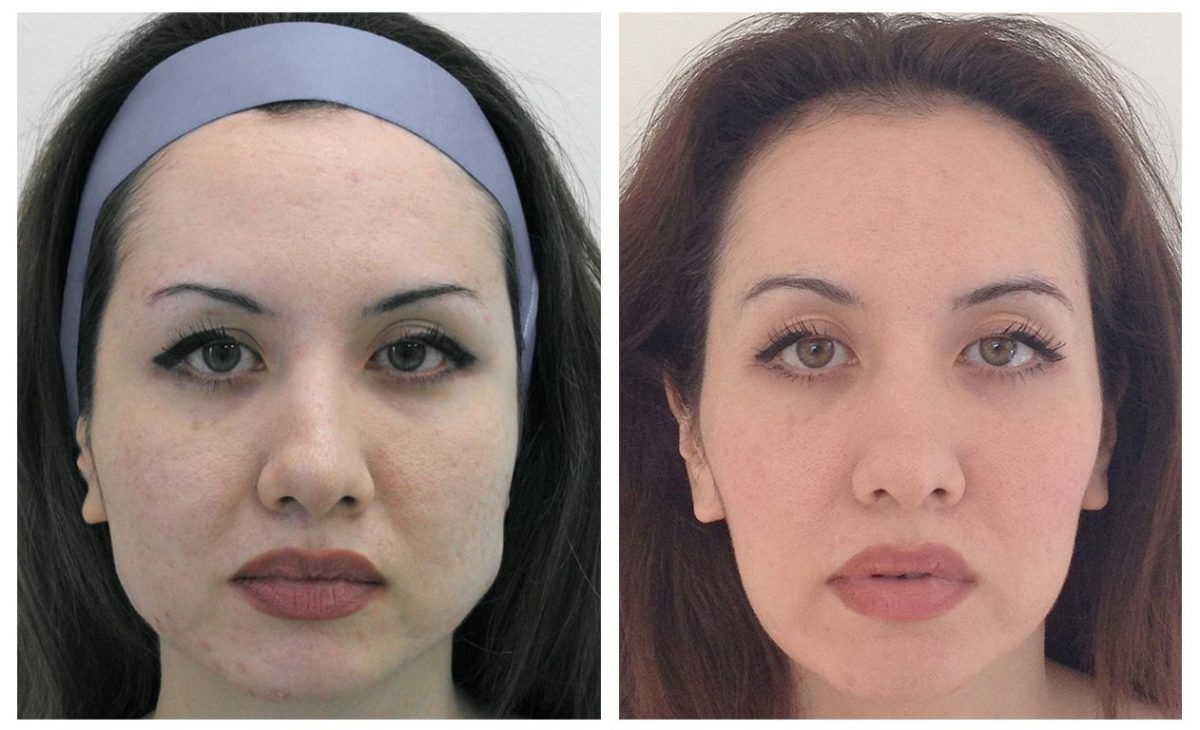 Before & After Facial Slimming