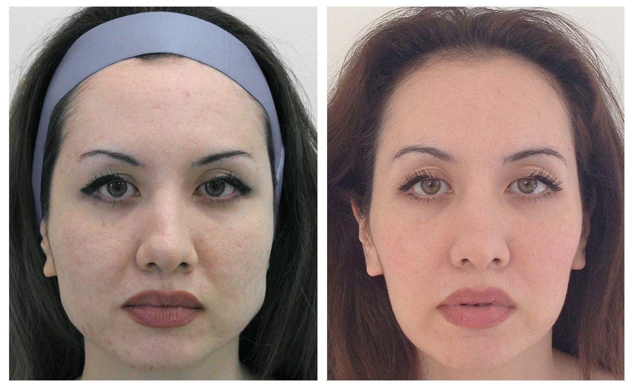 Facial Slimming DrBK Cosmetic Dentist & Aesthetics Clinic in Reading