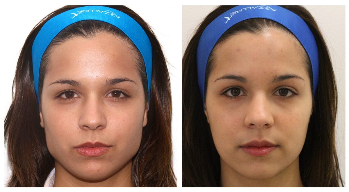 Before & After Facial Slimming