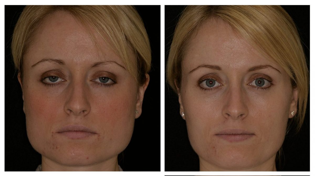Before & After Facial Slimming Before & After Facial Slimming