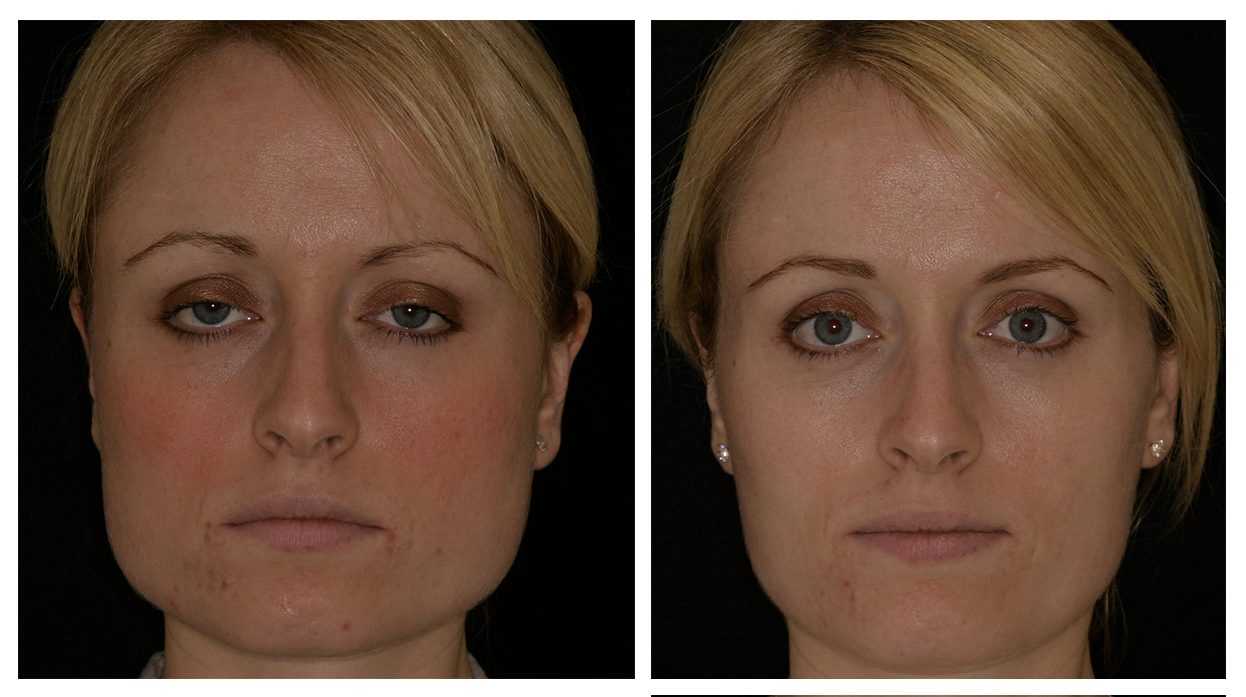 Before & After Facial Slimming