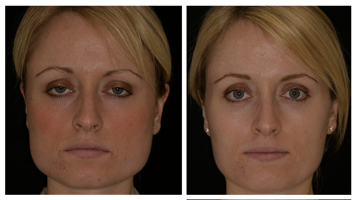 Teeth whitening laser reading