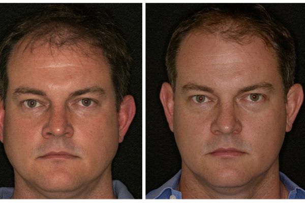 Before & After Facial Slimming Before & After Facial Slimming