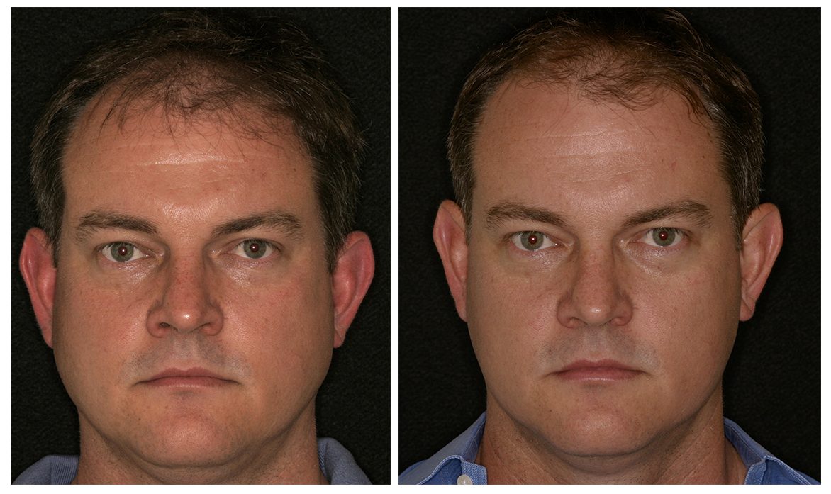 Before & After Facial Slimming Before & After Facial Slimming