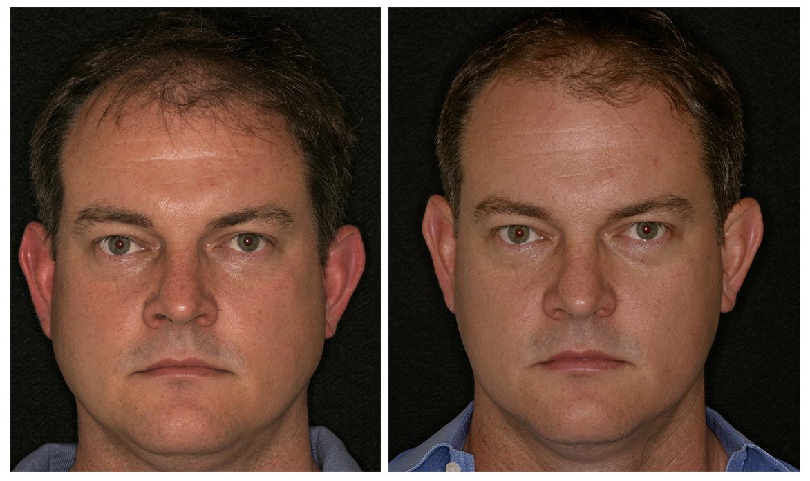 Before & After Facial Slimming