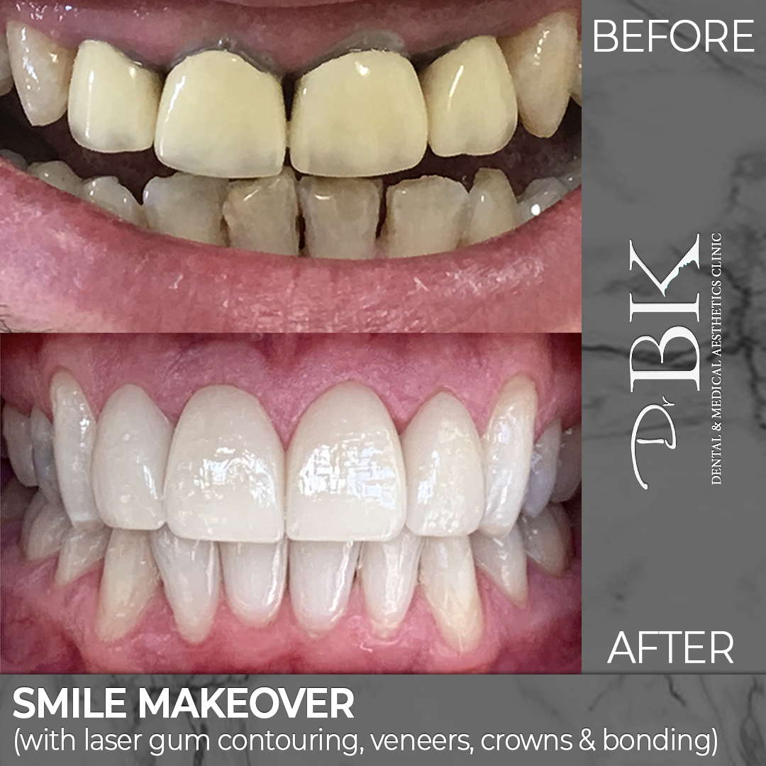 smile makeover