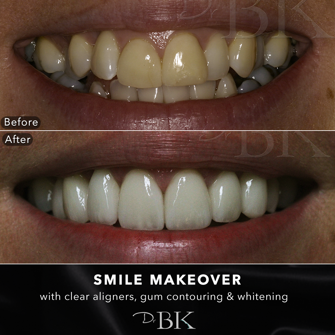smilemakeover2