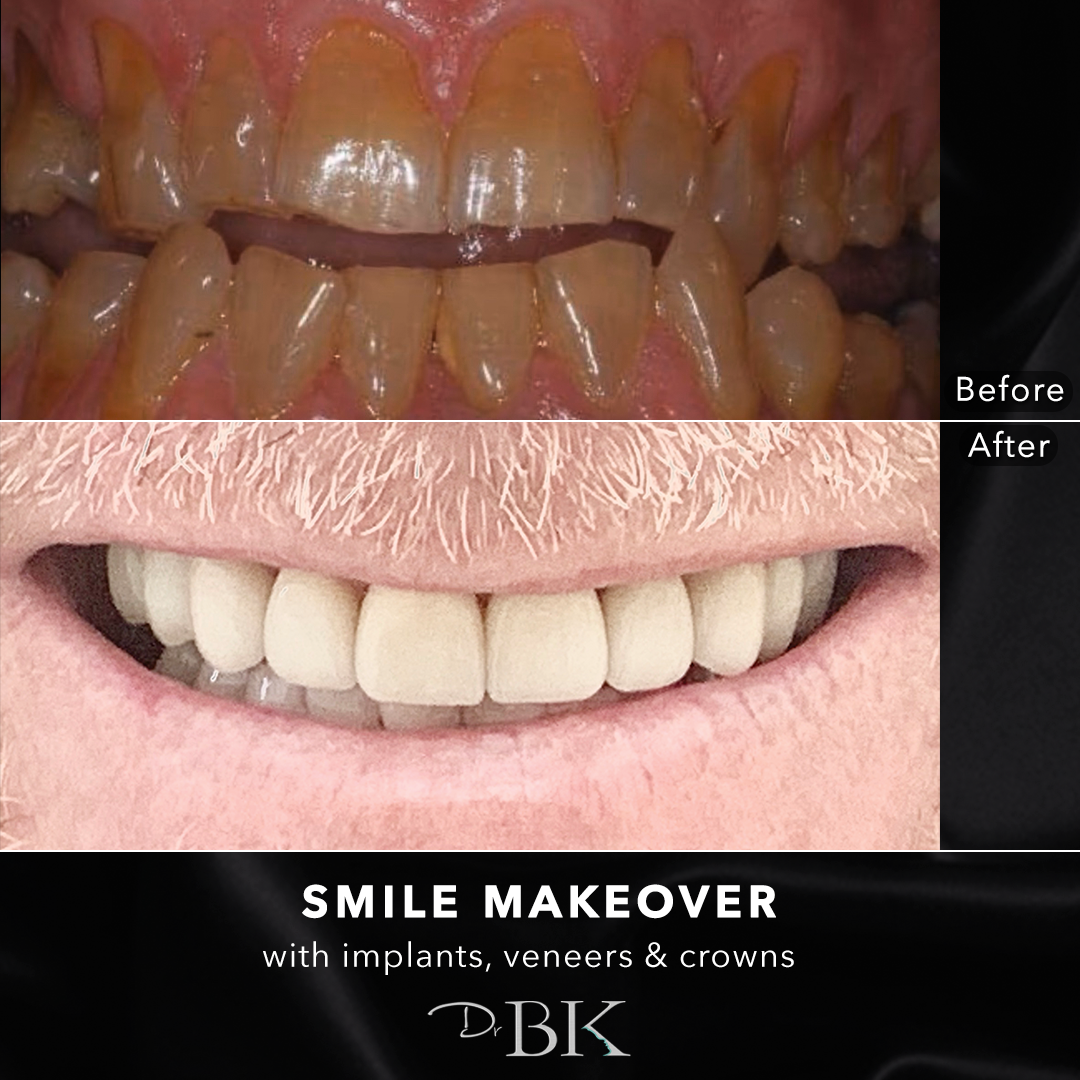 smilemakeover3