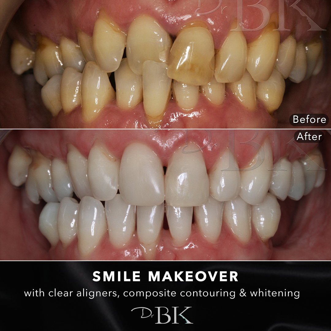 smilemakeover4
