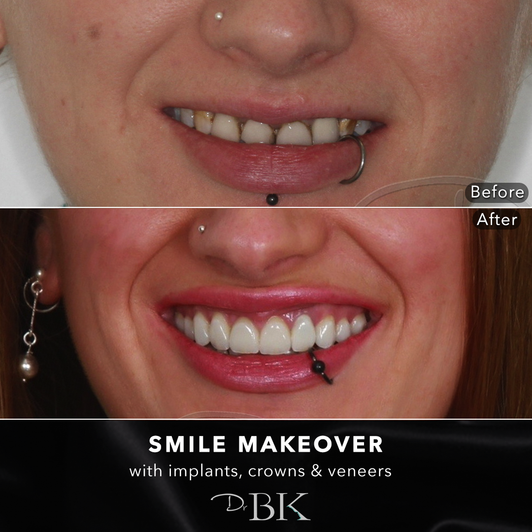 smilemakeover5
