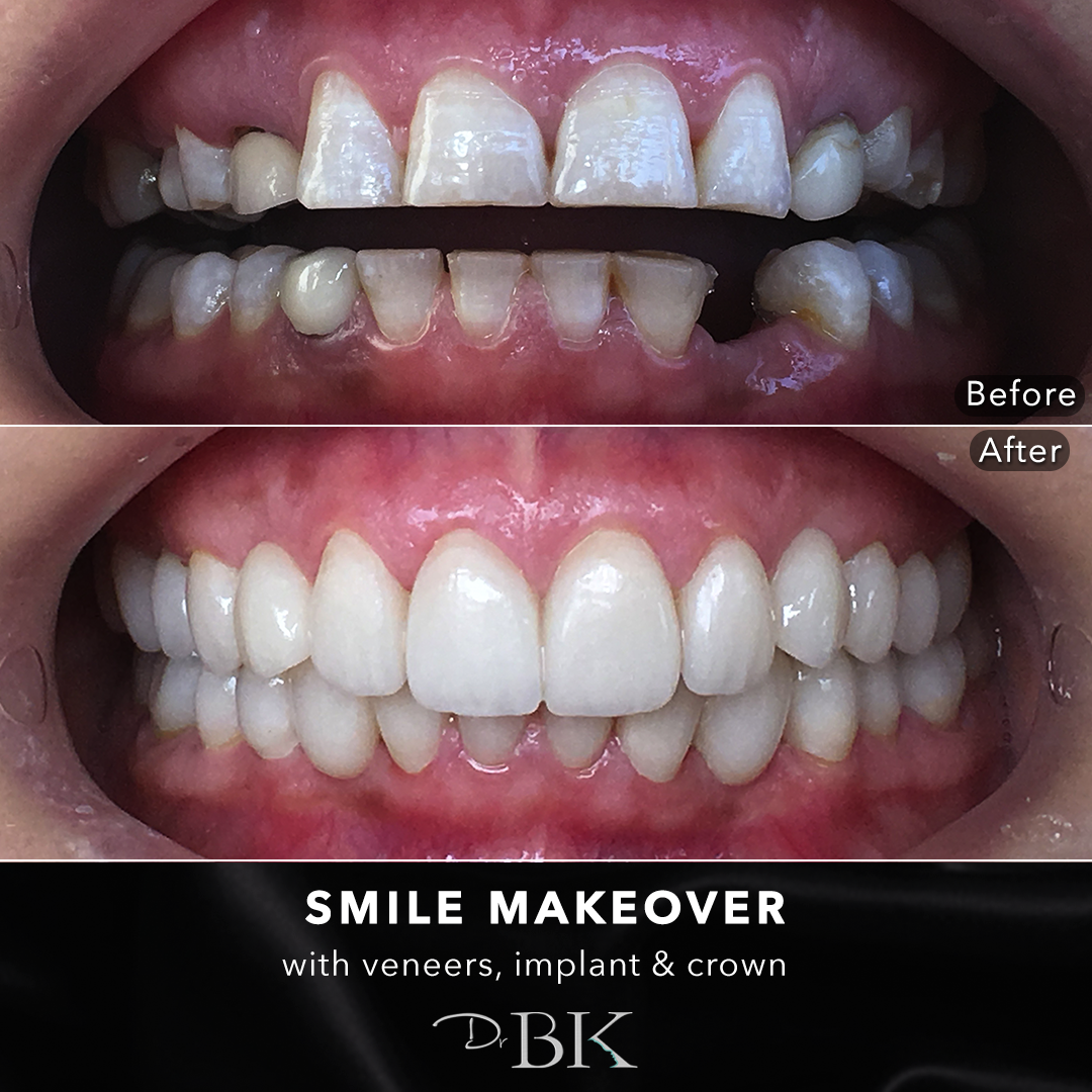 smilemakeover6