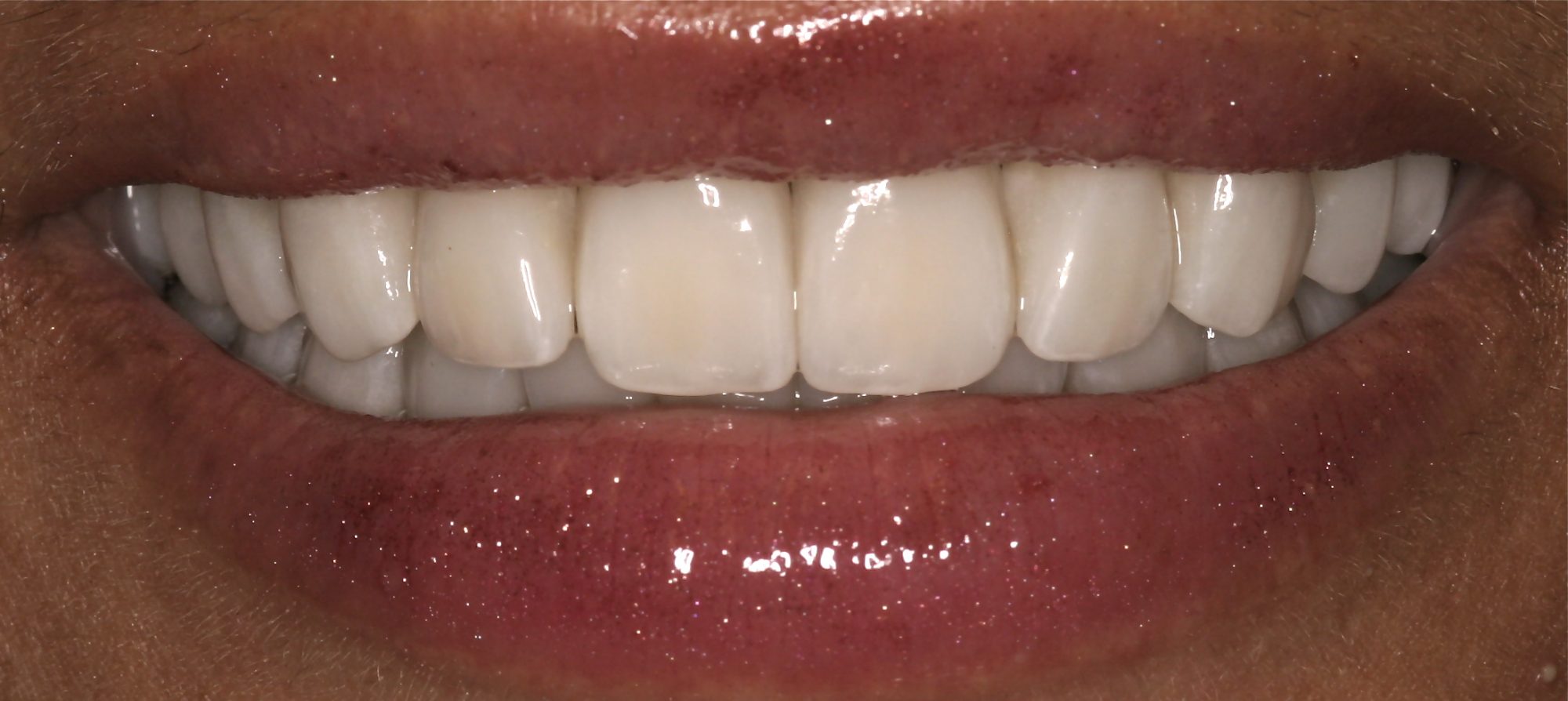 After Full Smile Makeover at DrBK After Full Smile Makeover at DrBK