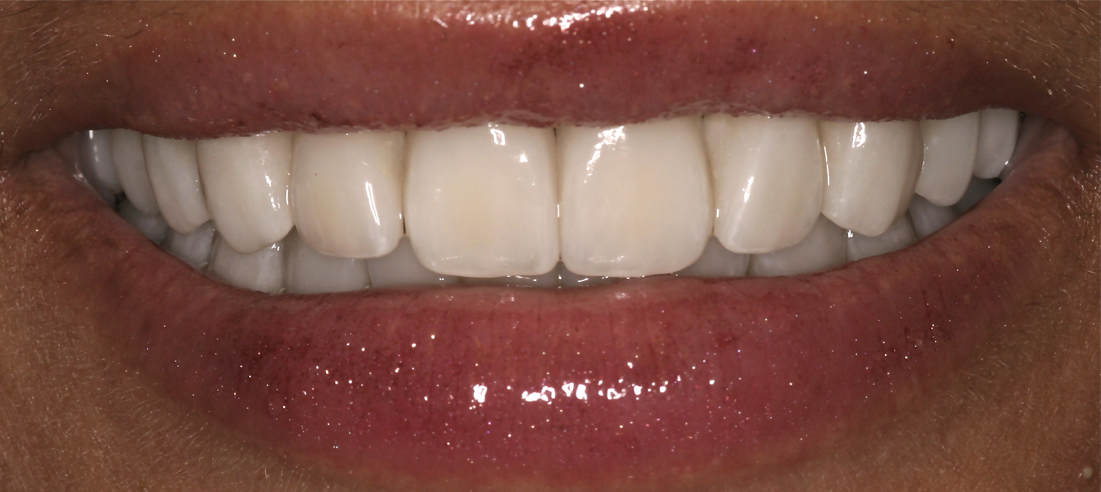 After Full Smile Makeover at DrBK After Full Smile Makeover at DrBK