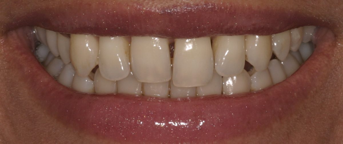 Before Full Smile Makeover at DrBK Before Full Smile Makeover at DrBK