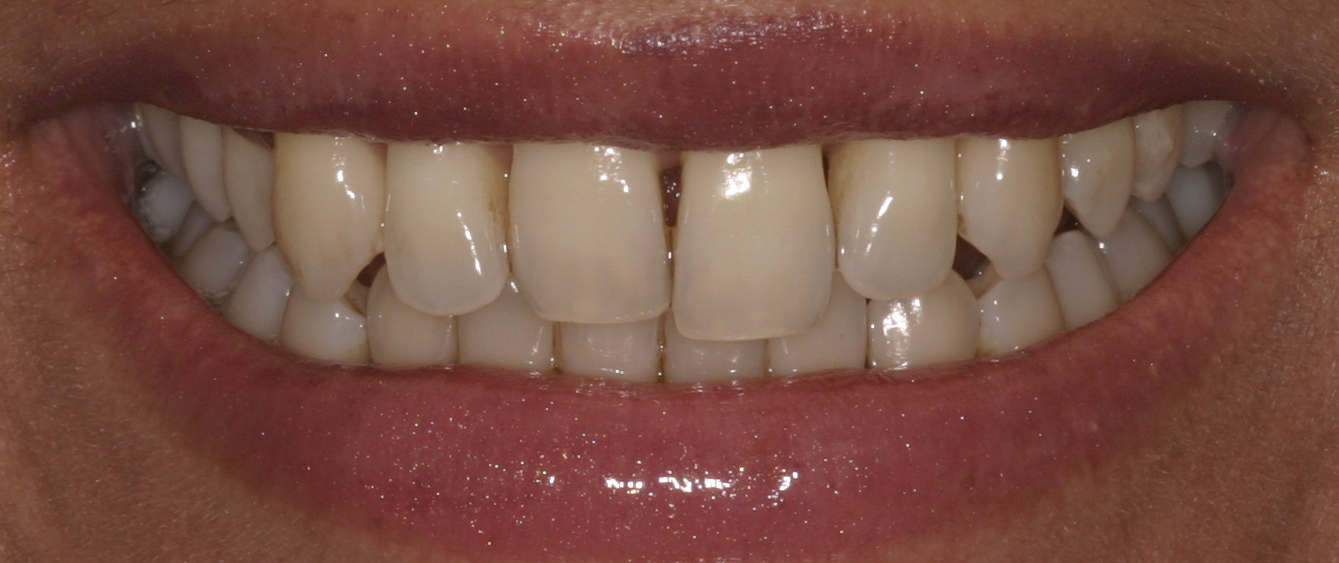 Before Full Smile Makeover at DrBK Before Full Smile Makeover at DrBK