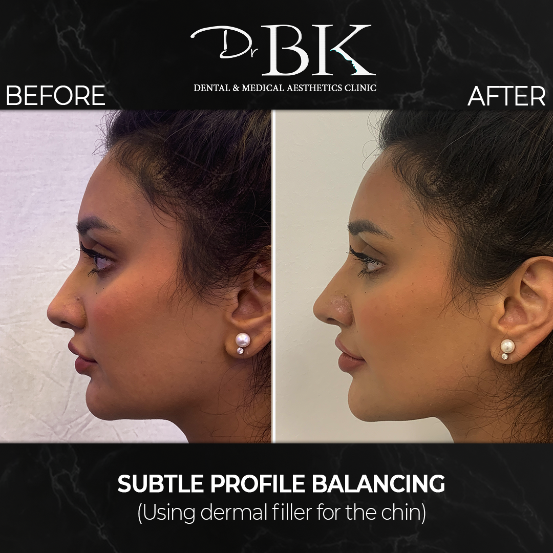 Chin Filler Chin Augmentation at DrBK Clinic in Reading