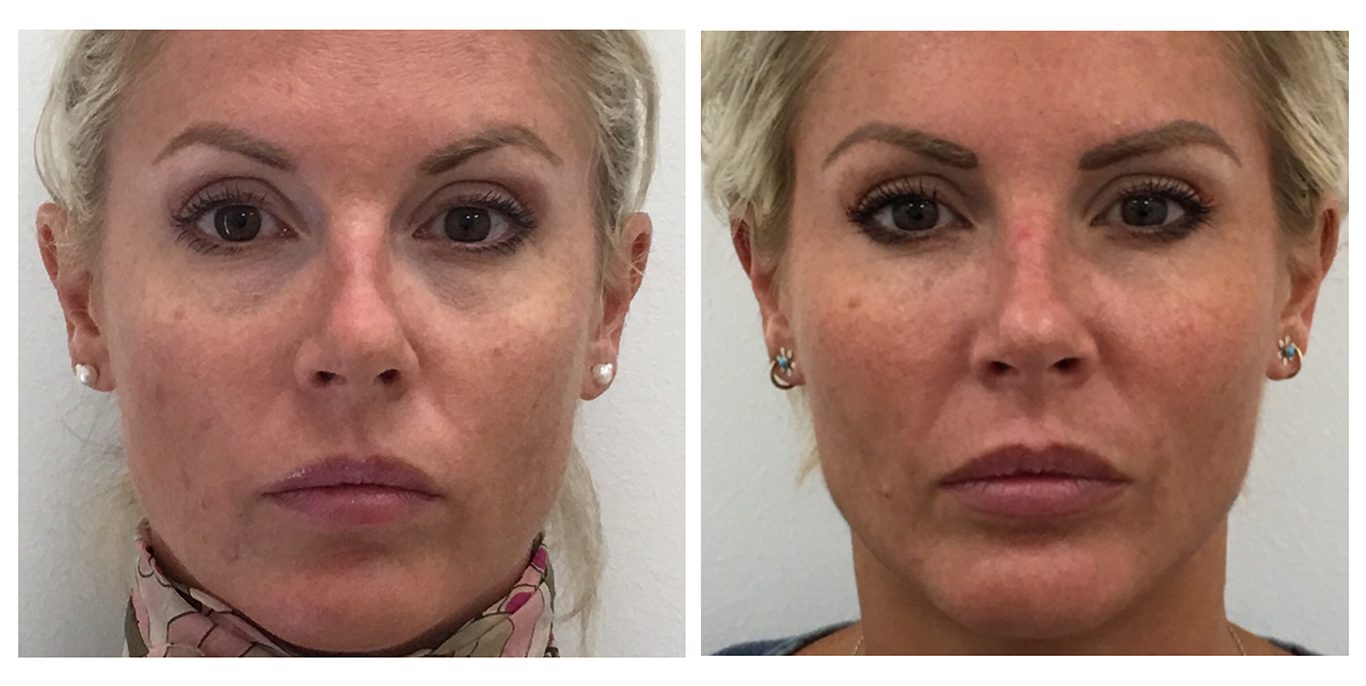 Tear Trough Treatment | DrBK Reading, Award Winning Clinic